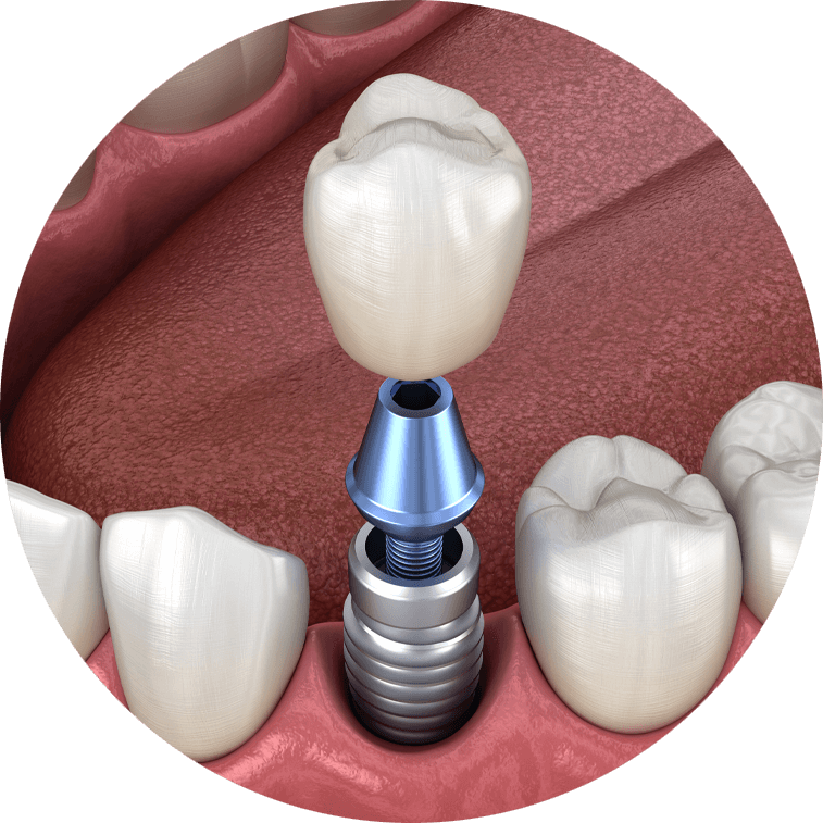 Could My Smile Be Restored With Full Mouth Dental Implants In Bronx, NY?