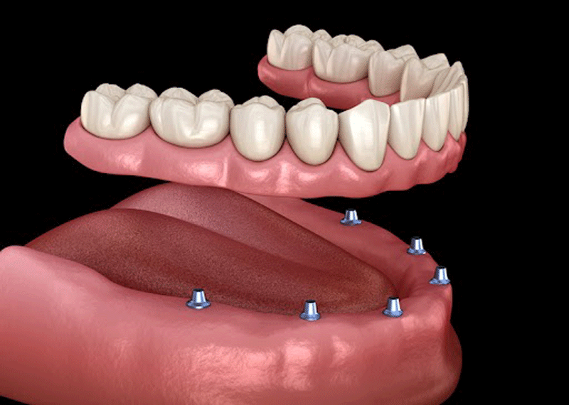 Ready To Learn How Full Mouth Dental Implants Are Cost-Effective?