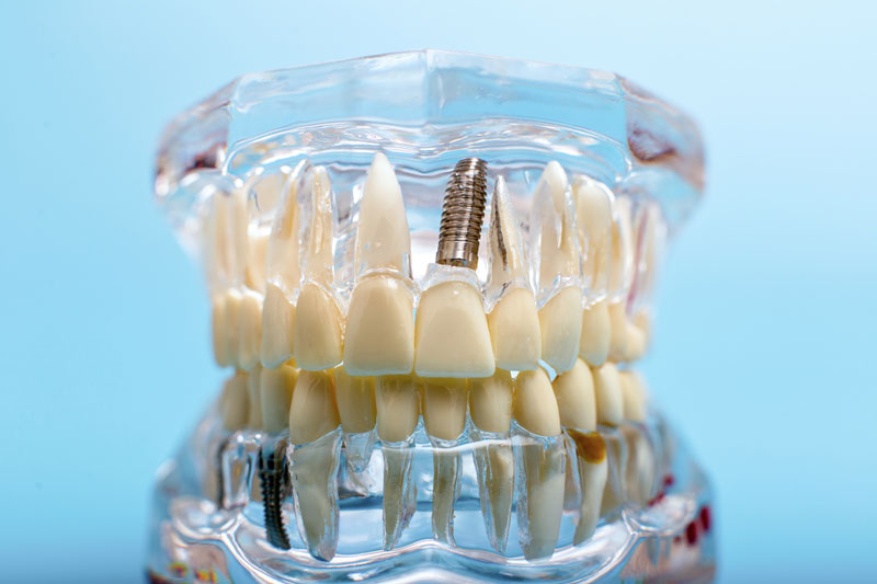 model of tooth implants with clear holders to see the implant through the "gums".