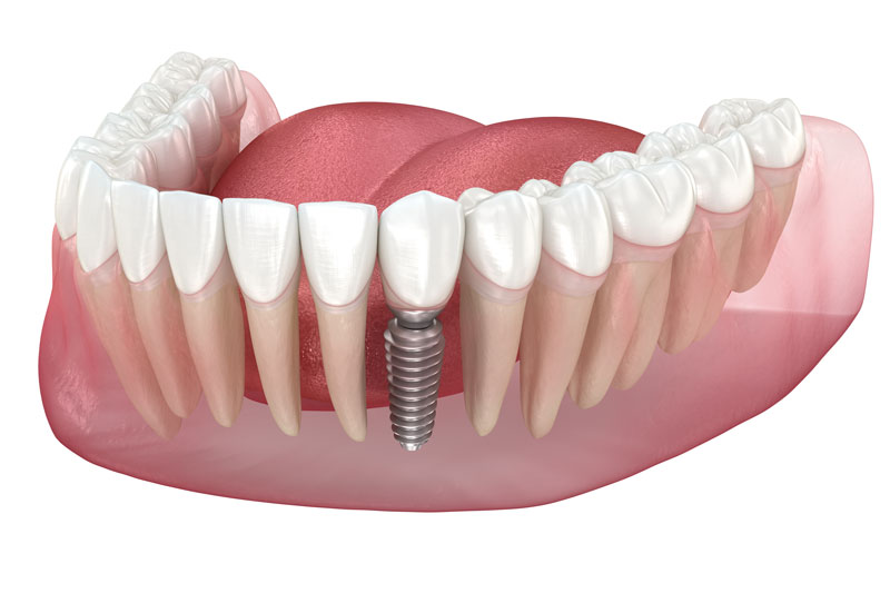 What Is That Implant? A Guide To Understanding Dental Implants